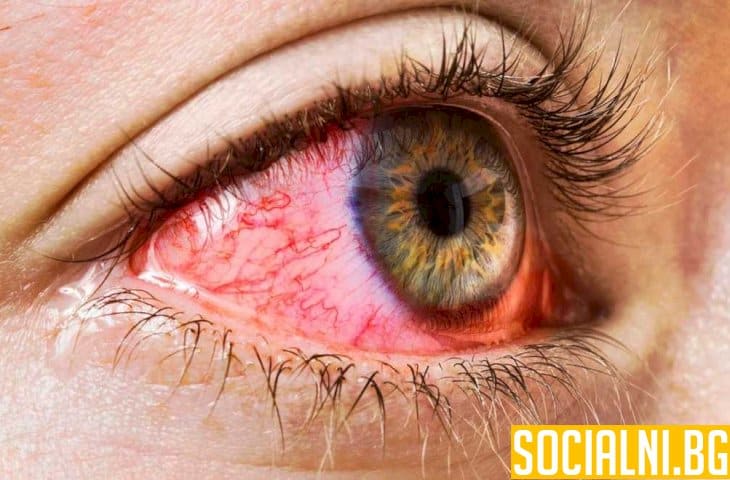 Конюктивитът: едно от най-често срещаните възпаления на очите